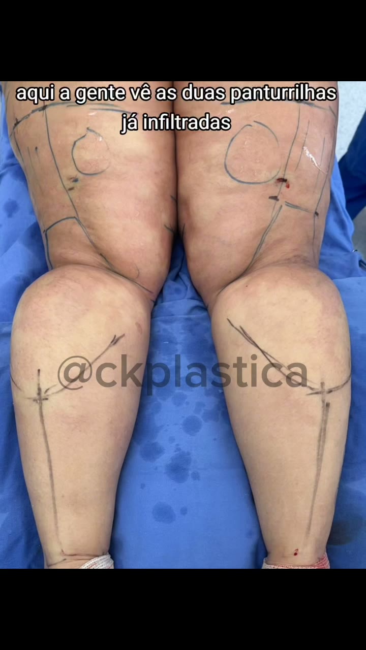 Oie! Vamos ver essa cirurgia comigo? Trouxe uma cirurgia de lipedema de membros inferiores.