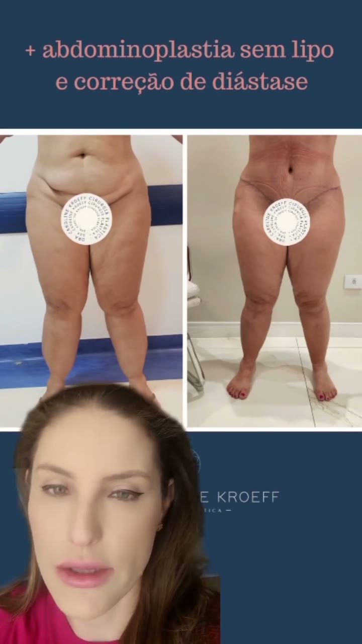 Olhem que legal este antes e depois de cirurgia de lipedema. Falando com a paciente se ela gostaria
