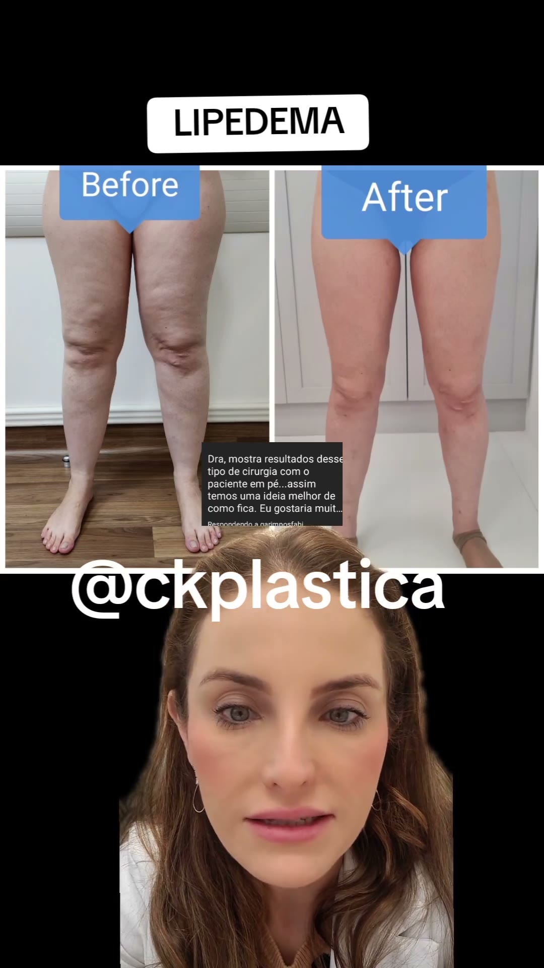 Siga pra mais conteúdos sobre cirurgia plástica e cirurgia de lipedema! Olhem esta evolução de 6 meses 🥰 Pretendo trazer