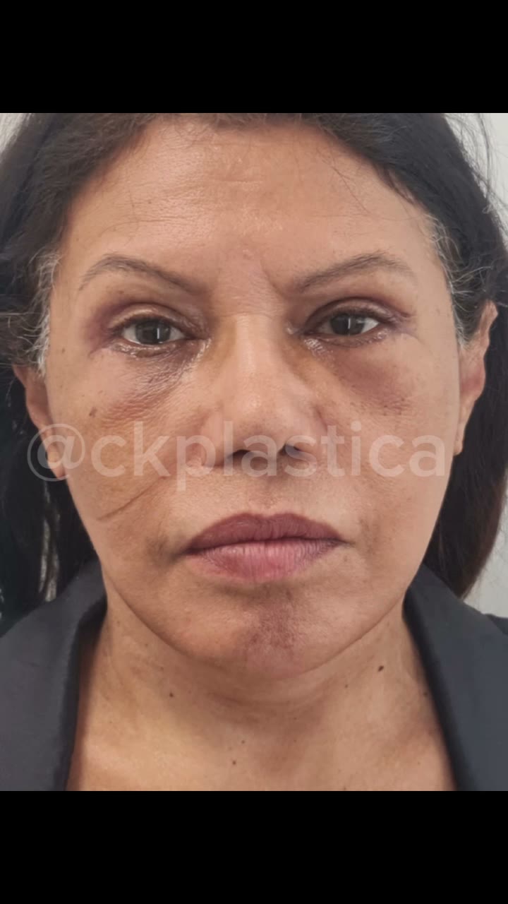 Transformação incrível! ✨ Confira o antes e depois deste facelift e veja como uma cirurgia bem-feita