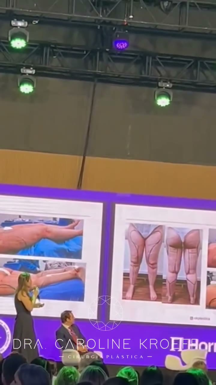 Que emoção foram esses dois dias intensos do 1° Congresso Brasileiro de Lipedema, em que pude estar