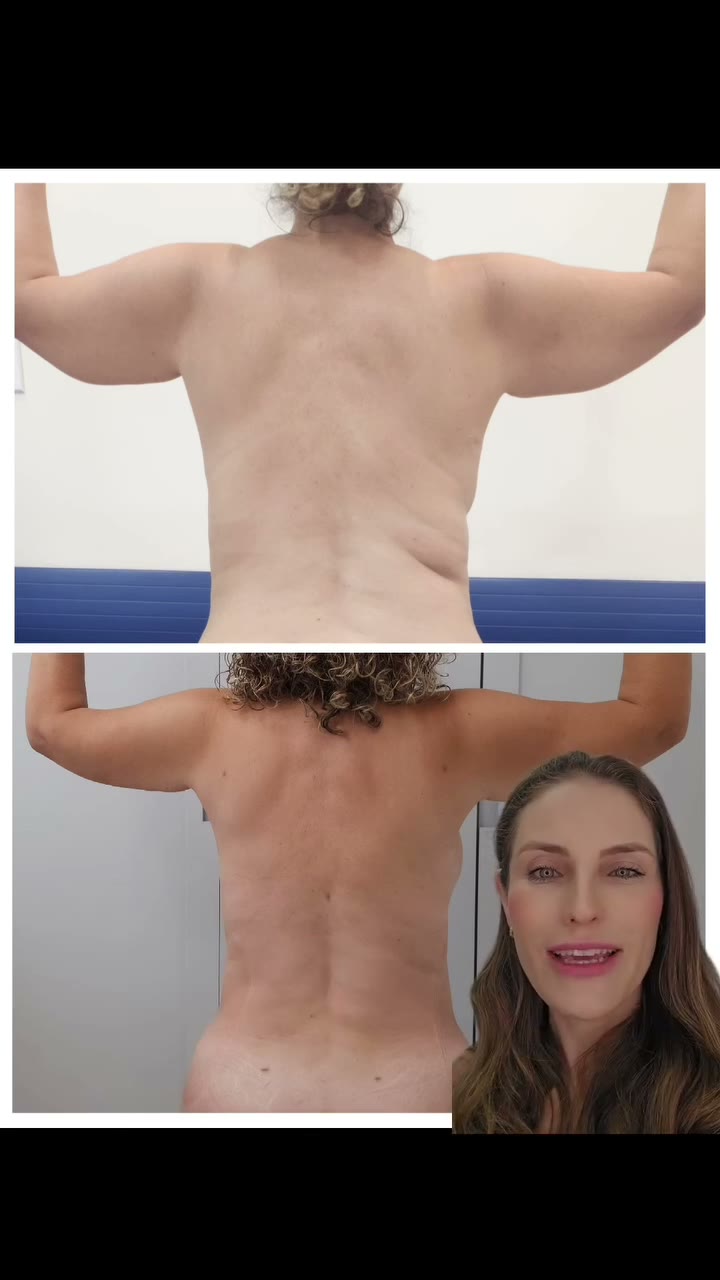 Lipoescultura com Argon para trazer melhora do contorno e da flacidez de pele 🥰🥰