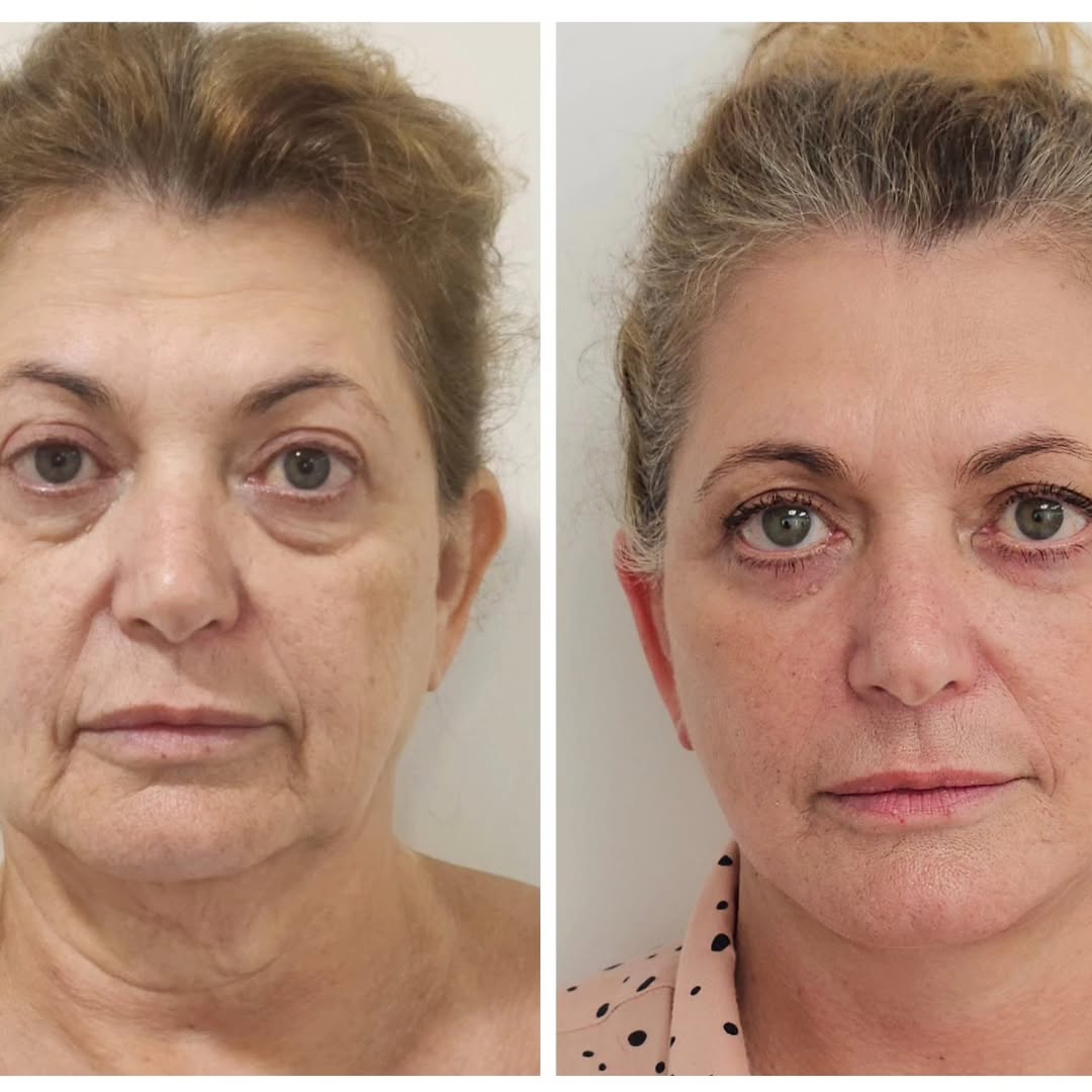 Você quer resultados mais expressivos para o seu rejuvenescimento facial? O lifting facial é uma alternativa cada vez ma (1/3)