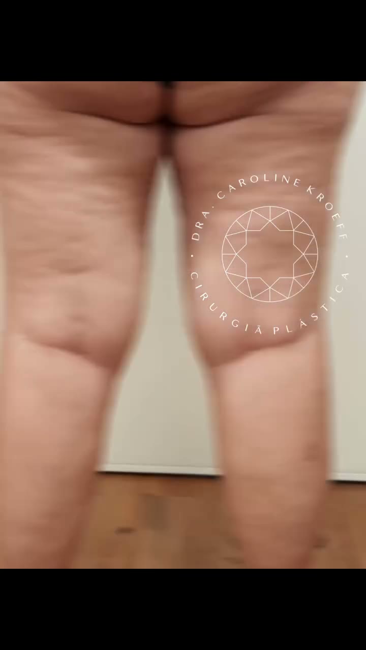Com quanto tempo dá pra ver os resultados da cirurgia de lipedema? Essa é uma das perguntas que mais