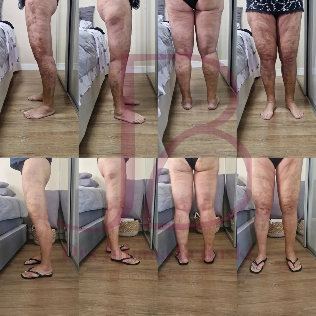A cirurgia de Lipedema é muito complexa e exige cuidados adequados. Procure sempre um profissional habilitado e com conh