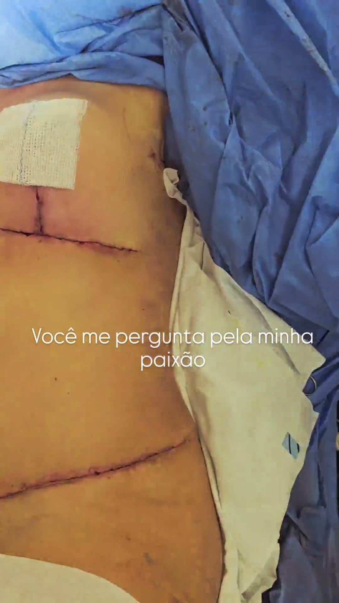 Essa trend ❤️🤏🏻 #CirurgiaPlástica #CirurgiaDeLipedema #Lipedema #mamoplastia
