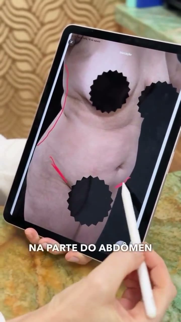 A gestação transforma o corpo e quando a flacidez e o excesso de pele permanecem, o contorno também
