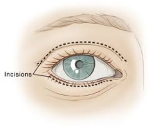 Começando a semana com uma cirurgia de #blefaroplastia superior e inferior. Uma cirurgia que dura em torno de 2 horas e  (2/2)