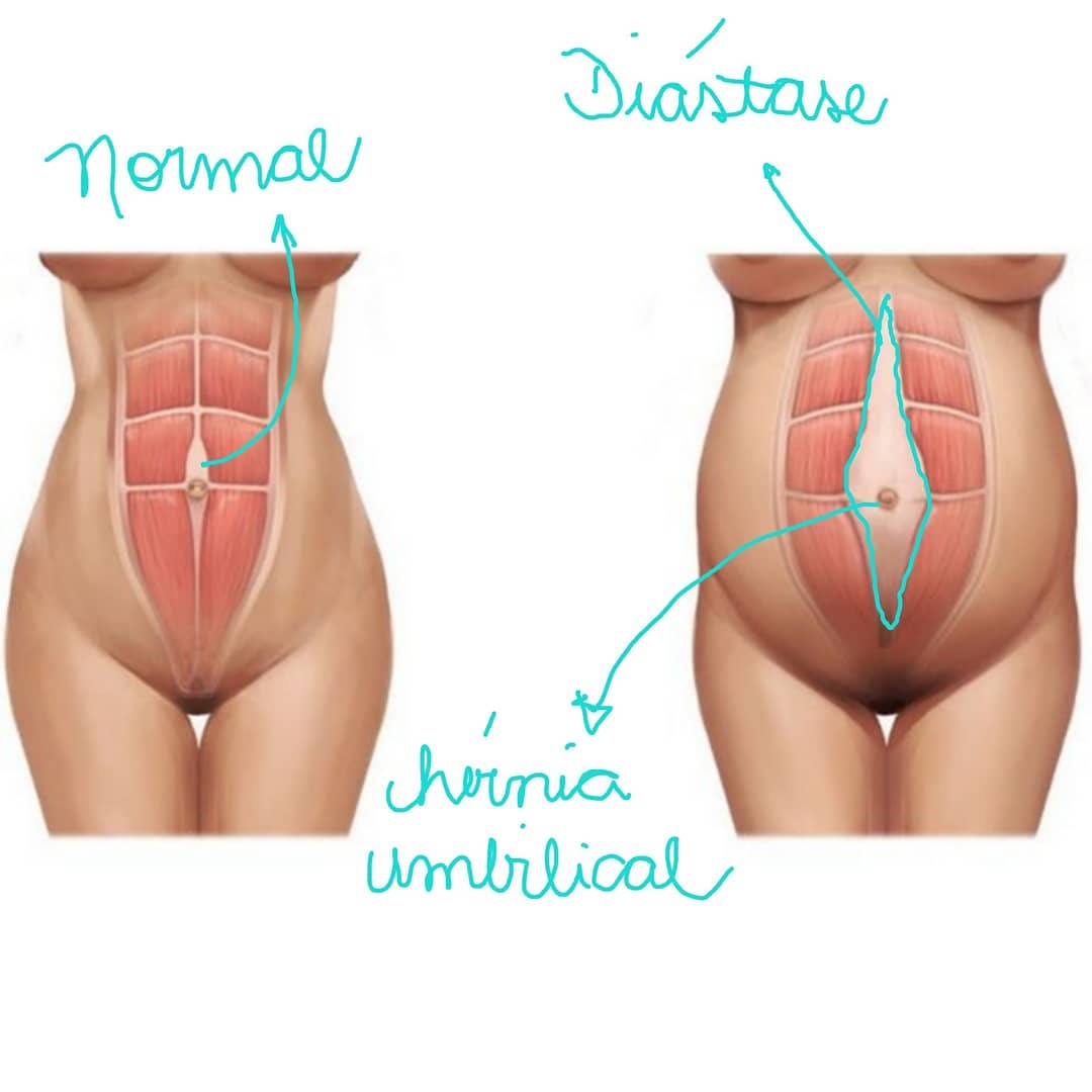 At the start of this year, we heard the news that First Lady Michelle Bolsonaro had breast implant replacement surgery, along with diastasis and umbil (2/2)