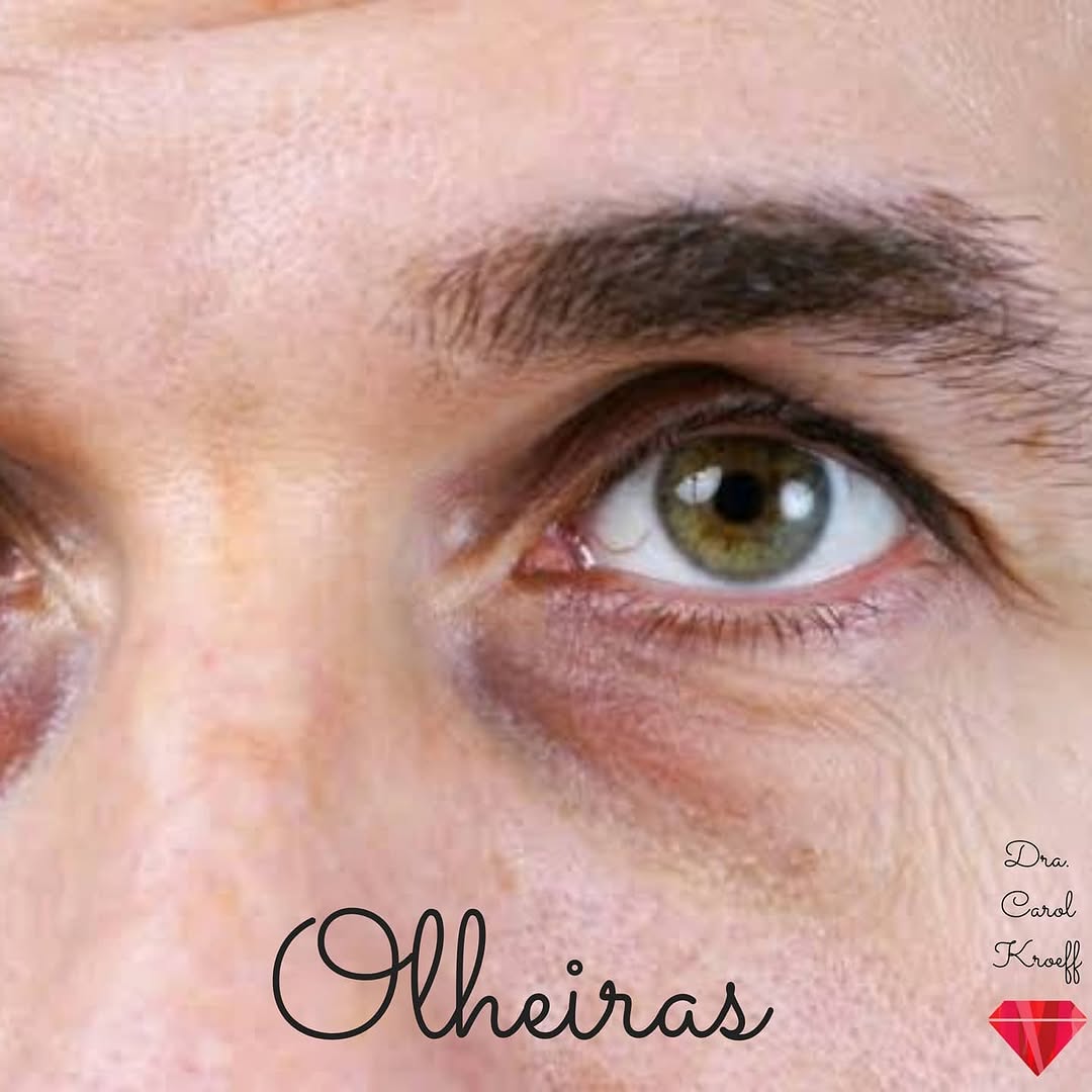 O maior desafio para o tratamento das #olheiras é justamente fazer o diagnóstico do problema, que muitas vezes vai além  (1/3)