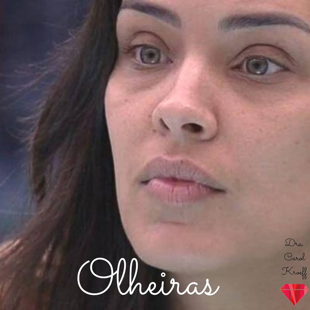 O maior desafio para o tratamento das #olheiras é justamente fazer o diagnóstico do problema, que muitas vezes vai além  (3/3)
