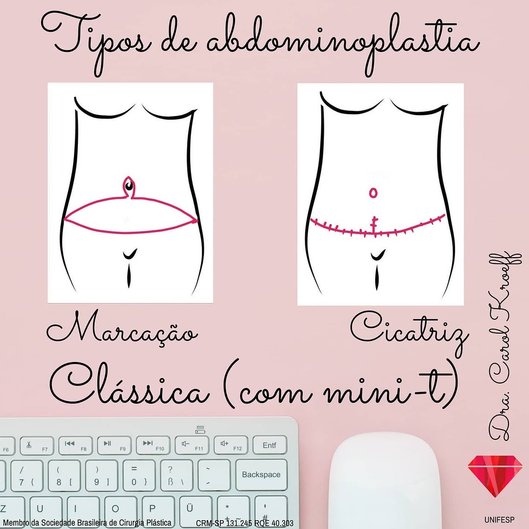 Many patients and followers always ask about the differences between types of abdominoplasty. (2/4)