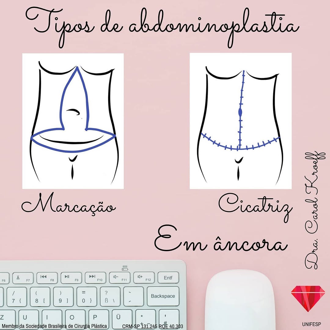 Many patients and followers always ask about the differences between types of abdominoplasty. (3/4)
