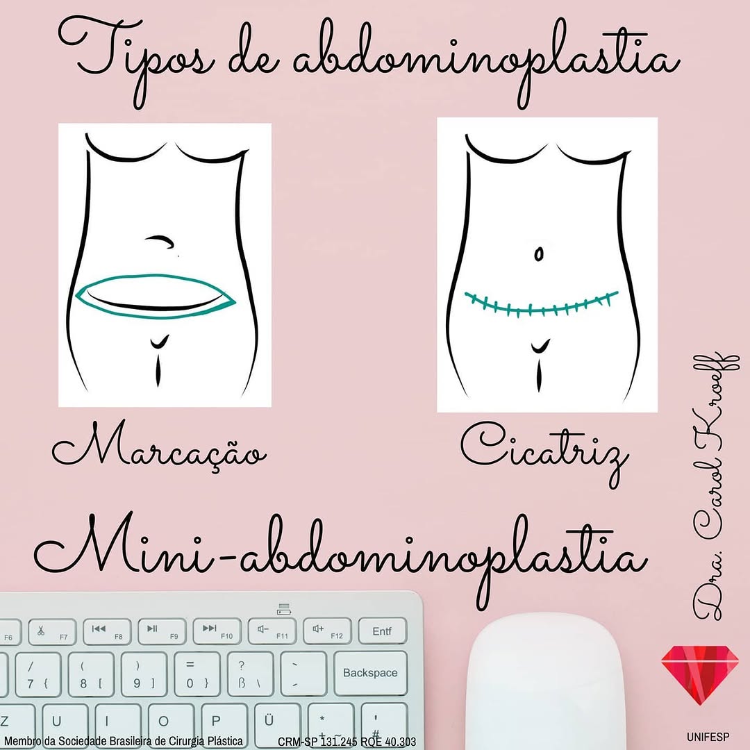 Many patients and followers always ask about the differences between types of abdominoplasty. (4/4)