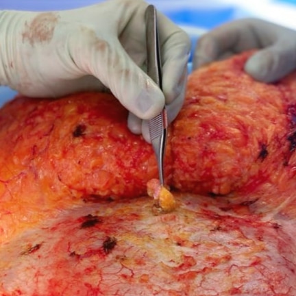 En la última foto hay algo sobre lo que muchas personas tienen dudas, y que puede ser corregido en la abdominoplastia… (4/4)