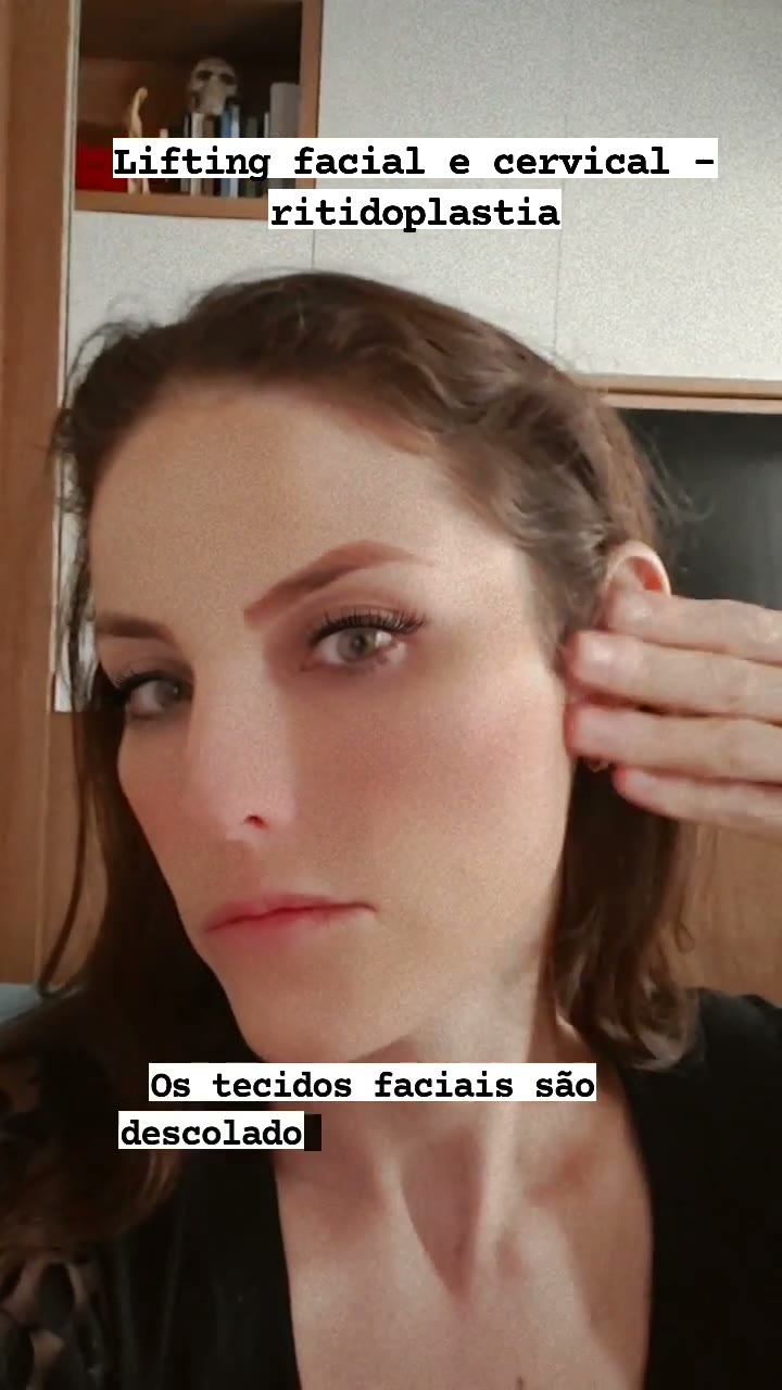 Lifting facial ou ritidoplastia respondendo a perguntas da caixinha 💕 #plastica #autoestima #selfie