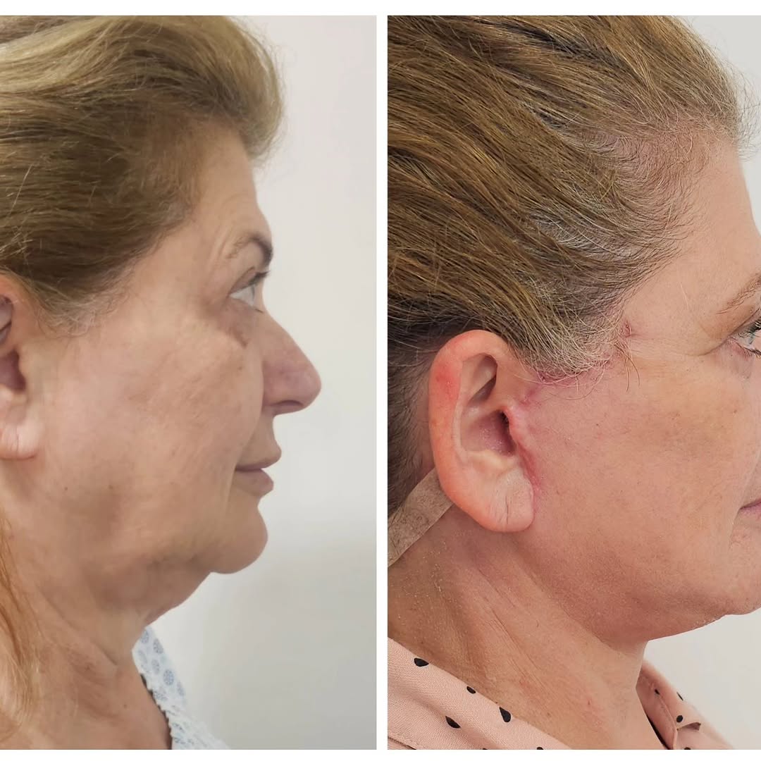 Você quer resultados mais expressivos para o seu rejuvenescimento facial? O lifting facial é uma alternativa cada vez ma (3/3)