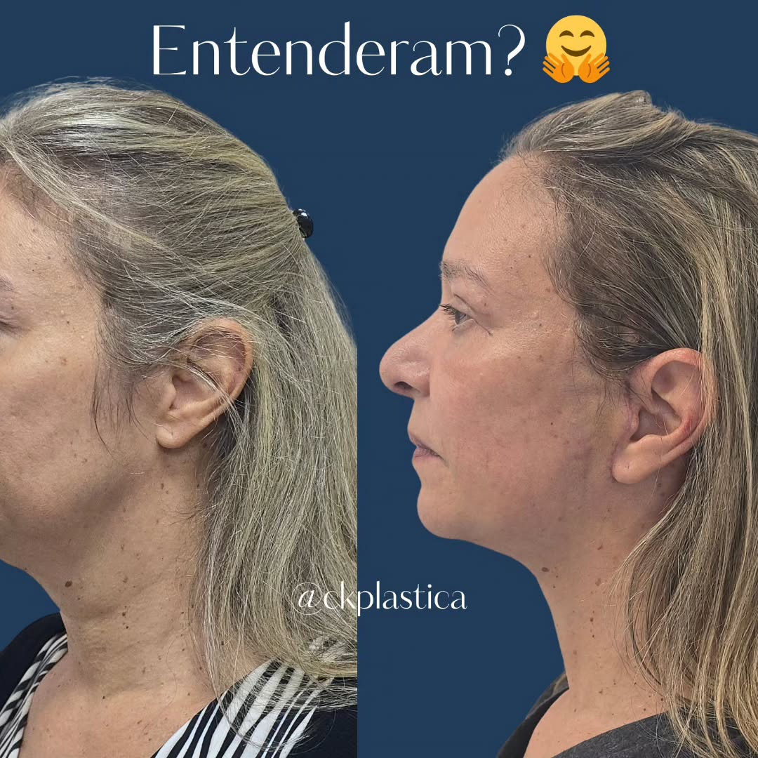 Duas semanas separam a data que estas fotos foram tiradas, após um lifting deep plane com blefaroplastia superior e infe (3/3)